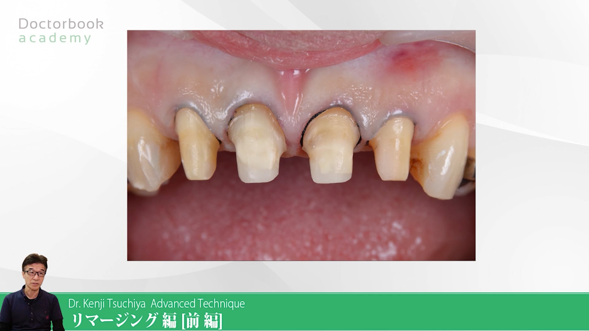 臨床知見録_プロビジョナル_唇側にも1層の新鮮面を出す意義