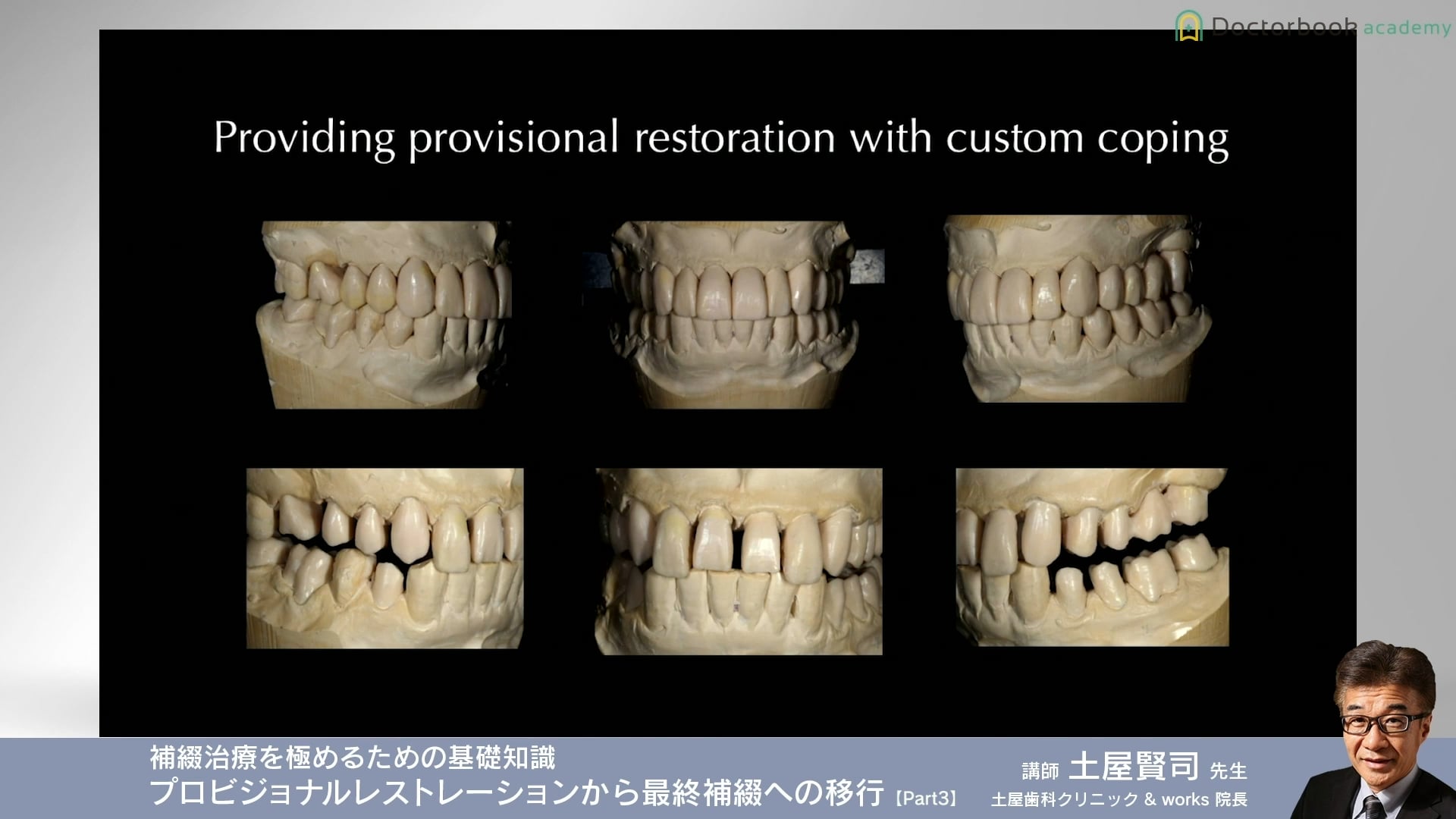 臨床知見録_プロビジョナル_最終補綴へ移行する方法