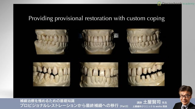 臨床知見録_プロビジョナル_最終補綴へ移行する方法