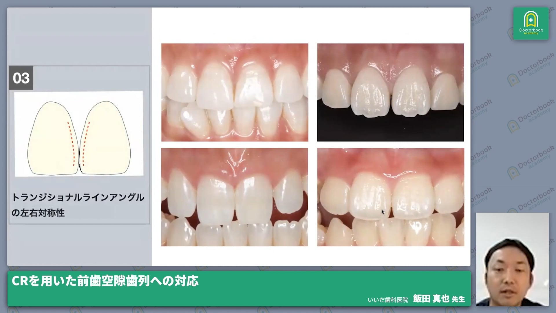 CRを用いた前歯空隙歯列への対応│CRコングレス～CR・接着の真価を再考する～