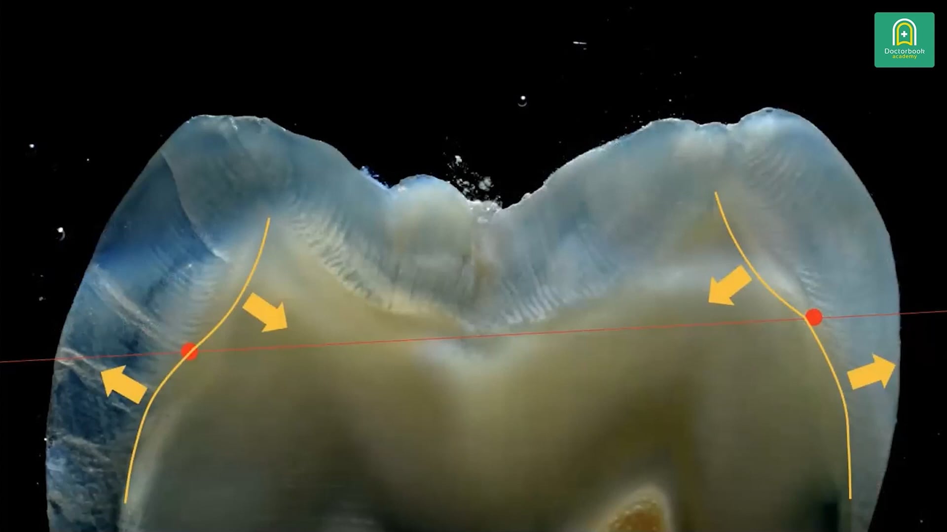 Borderline of Posterior Direct Restorations & Onlay Overlay│CRコングレス～CR・接着の真価を再考する～