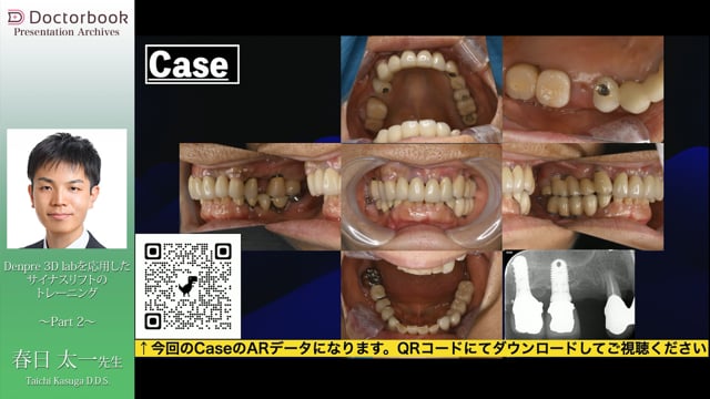 ５G・Metaverse・VR・SRPM・ARを活用したサイナスリフトの実際│Part2