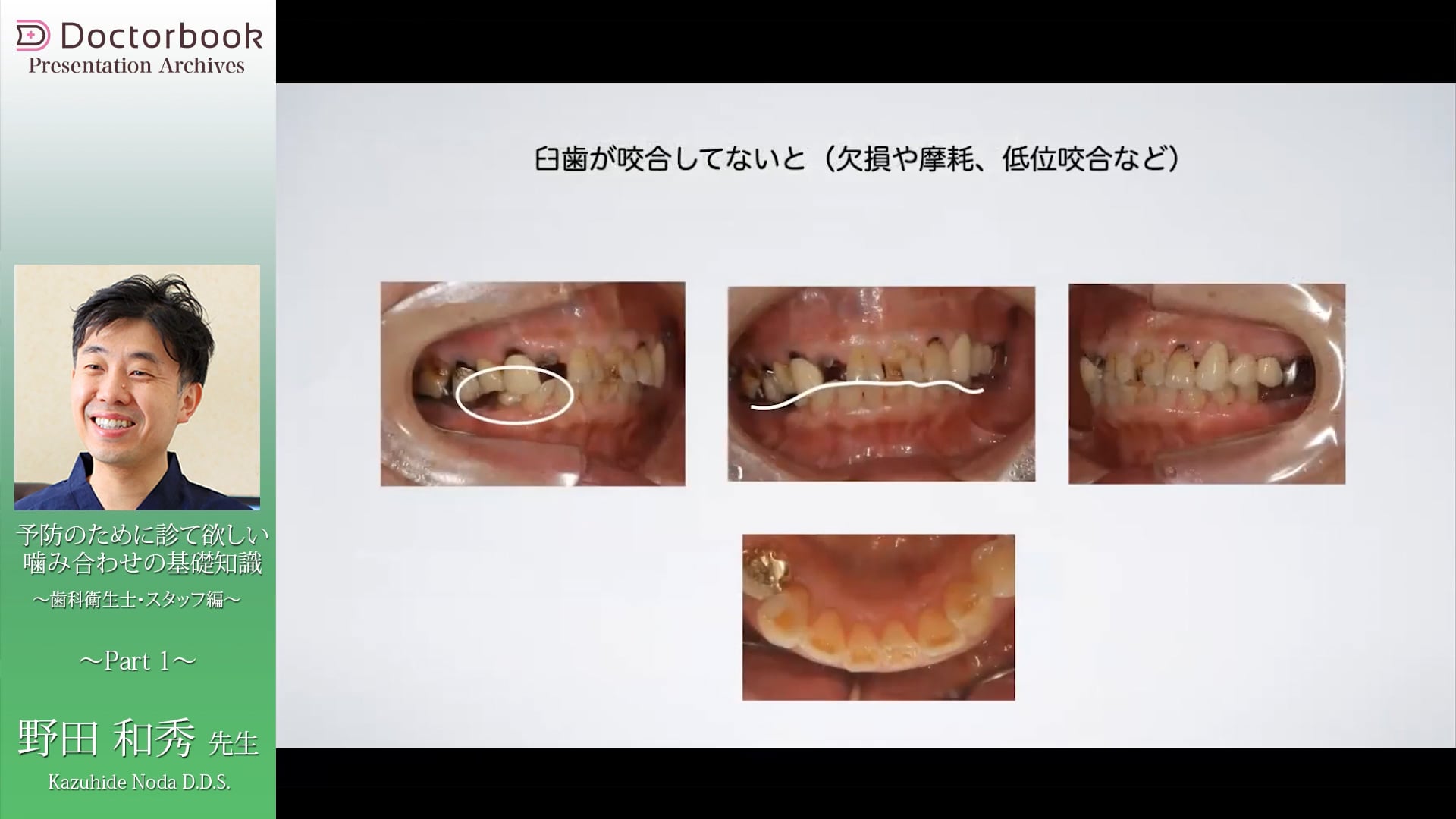 予防のために診てほしい 噛み合わせの基礎知識　歯科衛生士・スタッフ編　#1