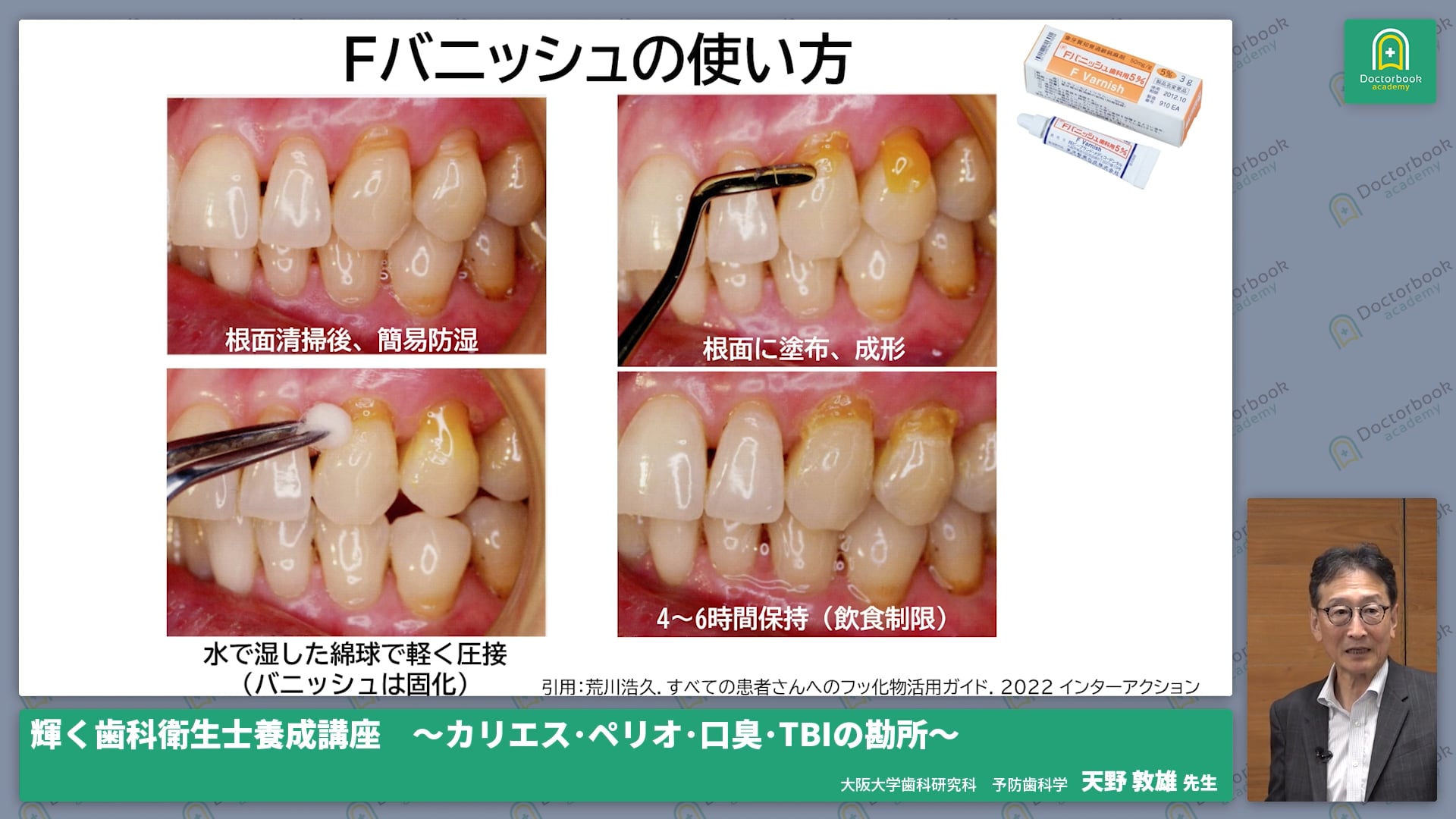 デンタルカリエス その病態と臨床マネージメント - 健康/医学