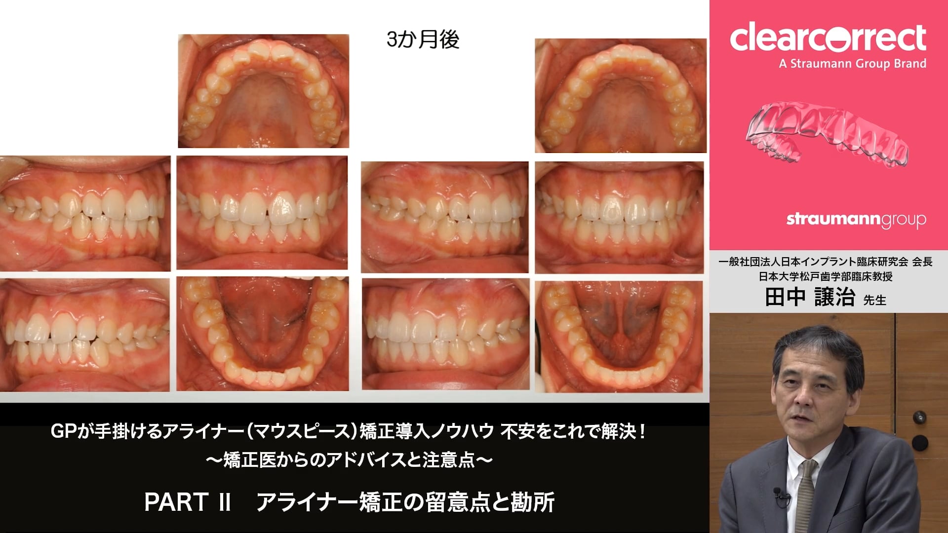 臨床知見録_アライナー矯正_正中離開