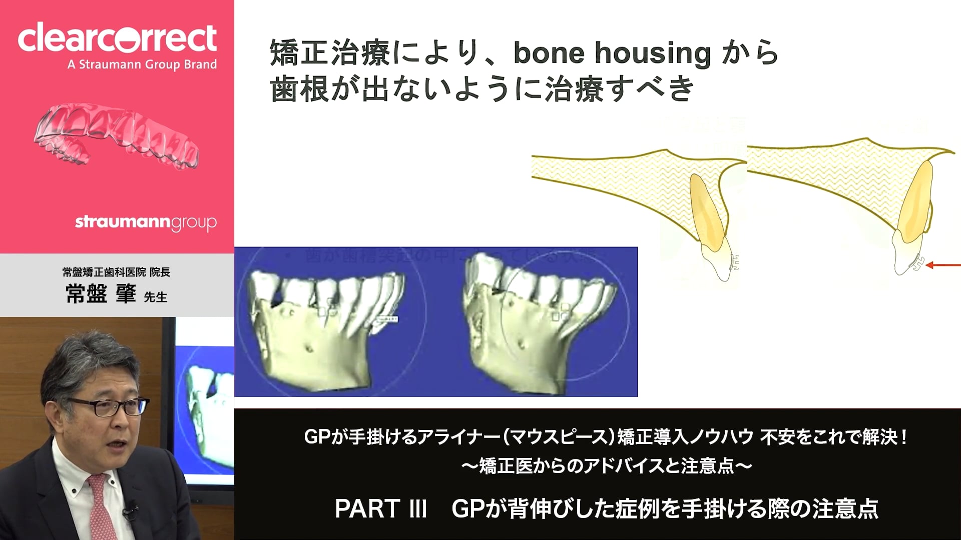 臨床知見録_アライナー矯正_MFT