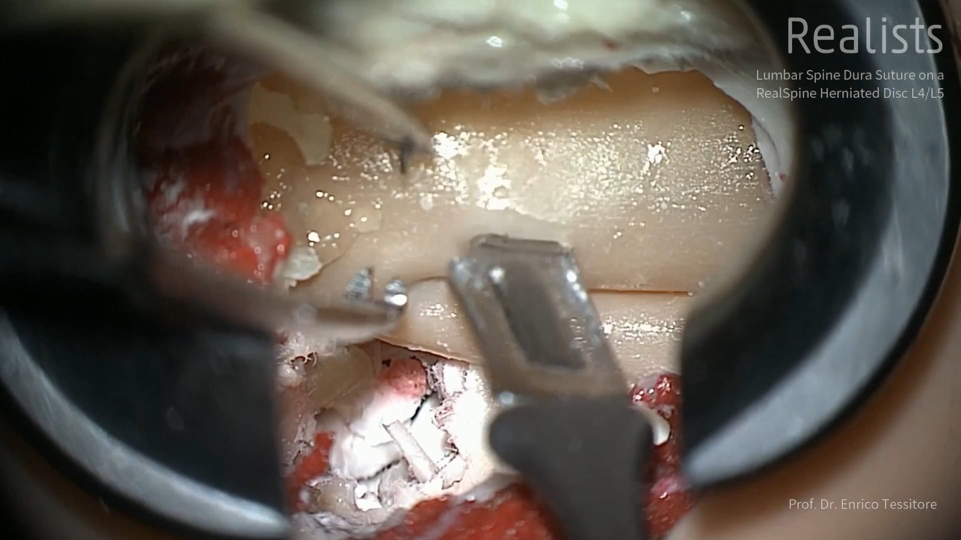 Lumbar Spine Dura Suture