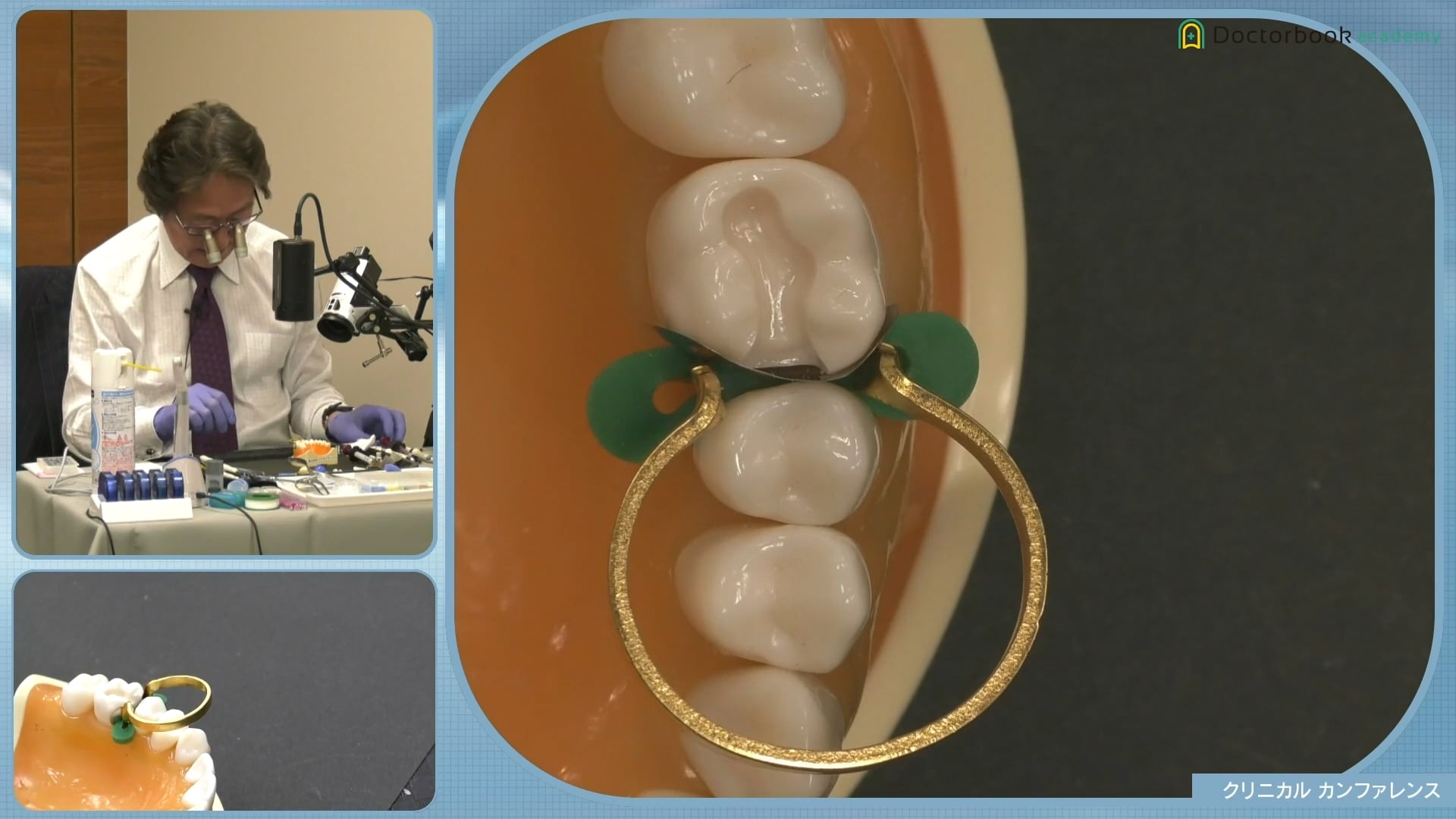臨床知見録_2級窩洞CR修復_象牙質の色味を隠す方法