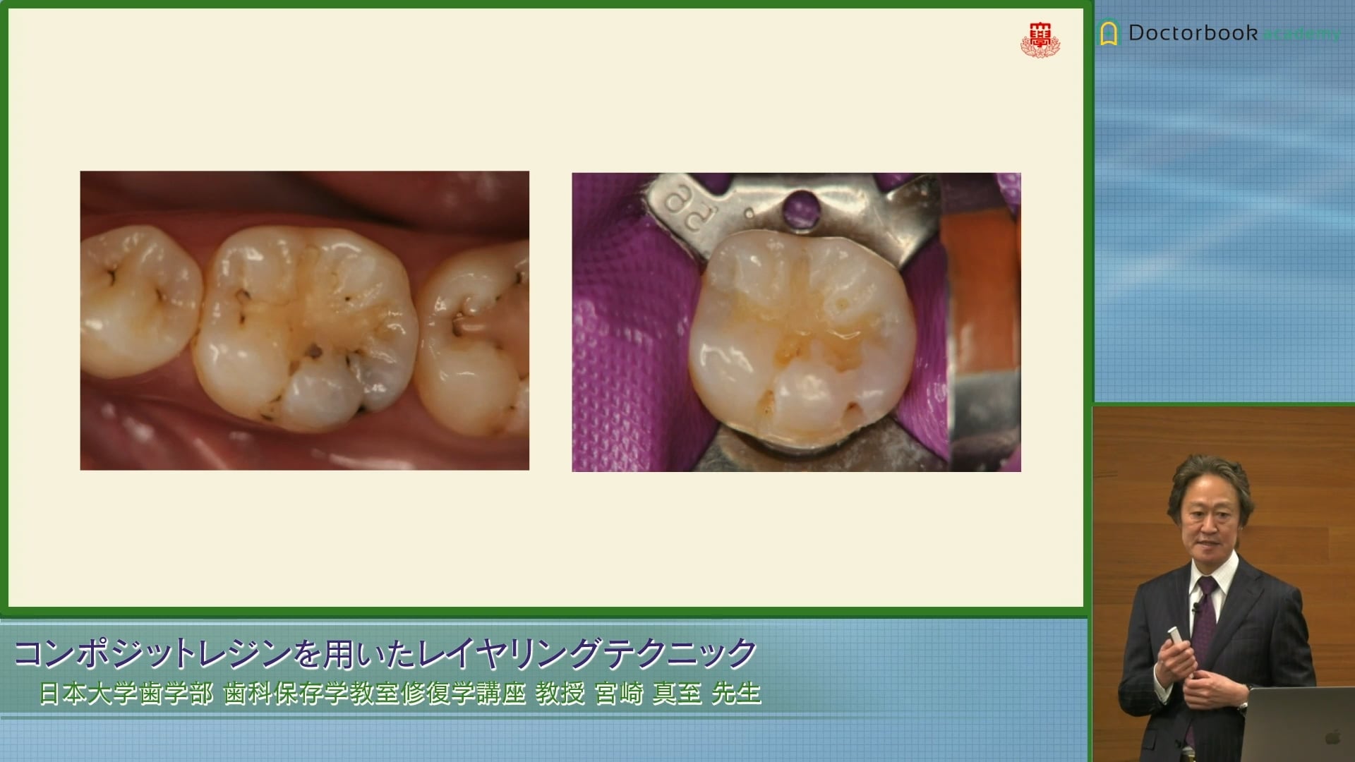 臨床知見録_2級窩洞CR修復_咬合面のフロー