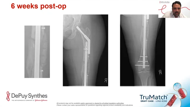 Vertebral Compression Fracture Overview, DePuy Synthes