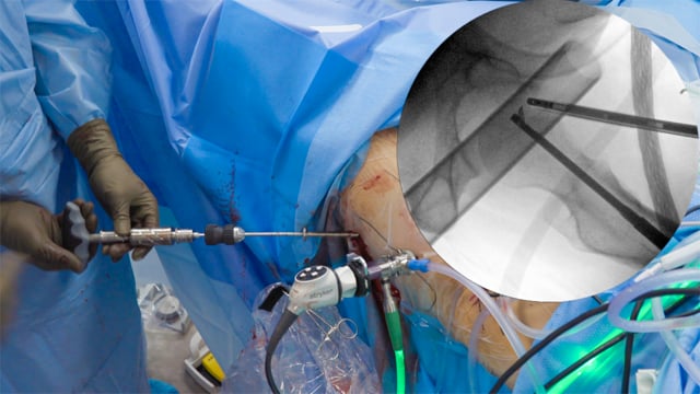 Arthroscopic Hip Labral Repair with Core Decompression for AVN of the Femoral Head