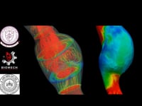 Newswise:Video Embedded detecting-predicting-and-preventing-aortic-ruptures-with-computational-modeling