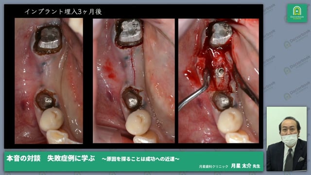 インプラント治療と自家歯牙移植の失敗について～失敗原因を深く考察する～│月星 太介先生 #1