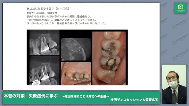 失敗症例に学ぶ本音の対談～原因を深く考査することが大切な理由～│月星 太介先生、相宮 秀俊先生 #3