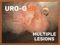 Uro-GHD - Multiple Lesions