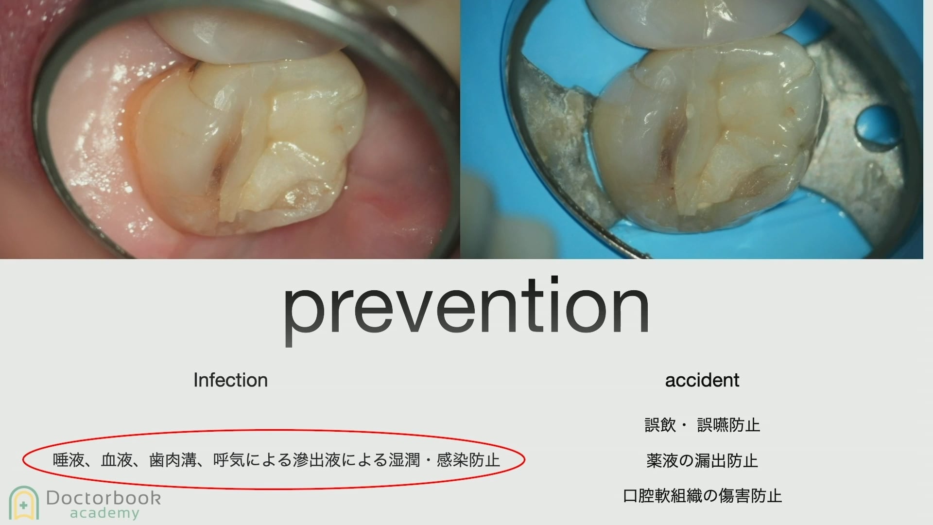 臨床知見録_ラバーダム_ラバーダム防湿を使う理由