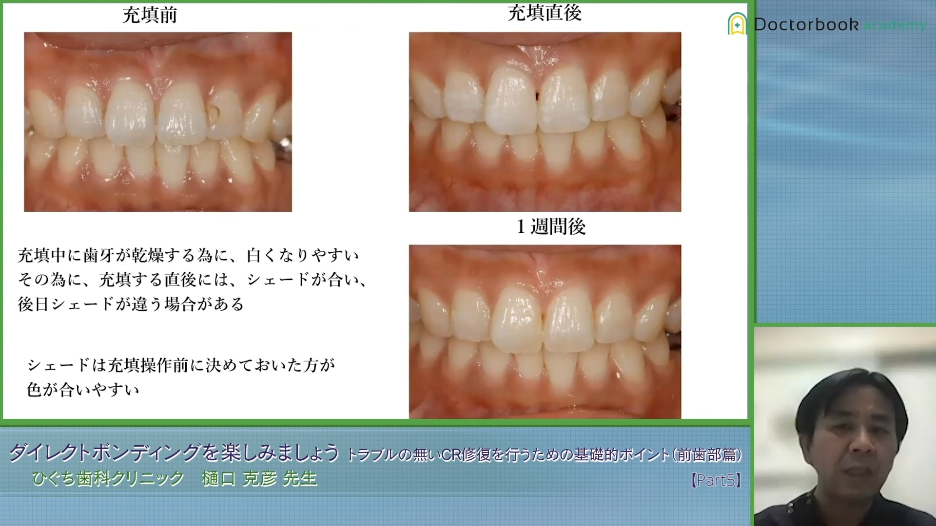 臨床知見録_4級窩洞CR修復_シェードテイキングのタイミング