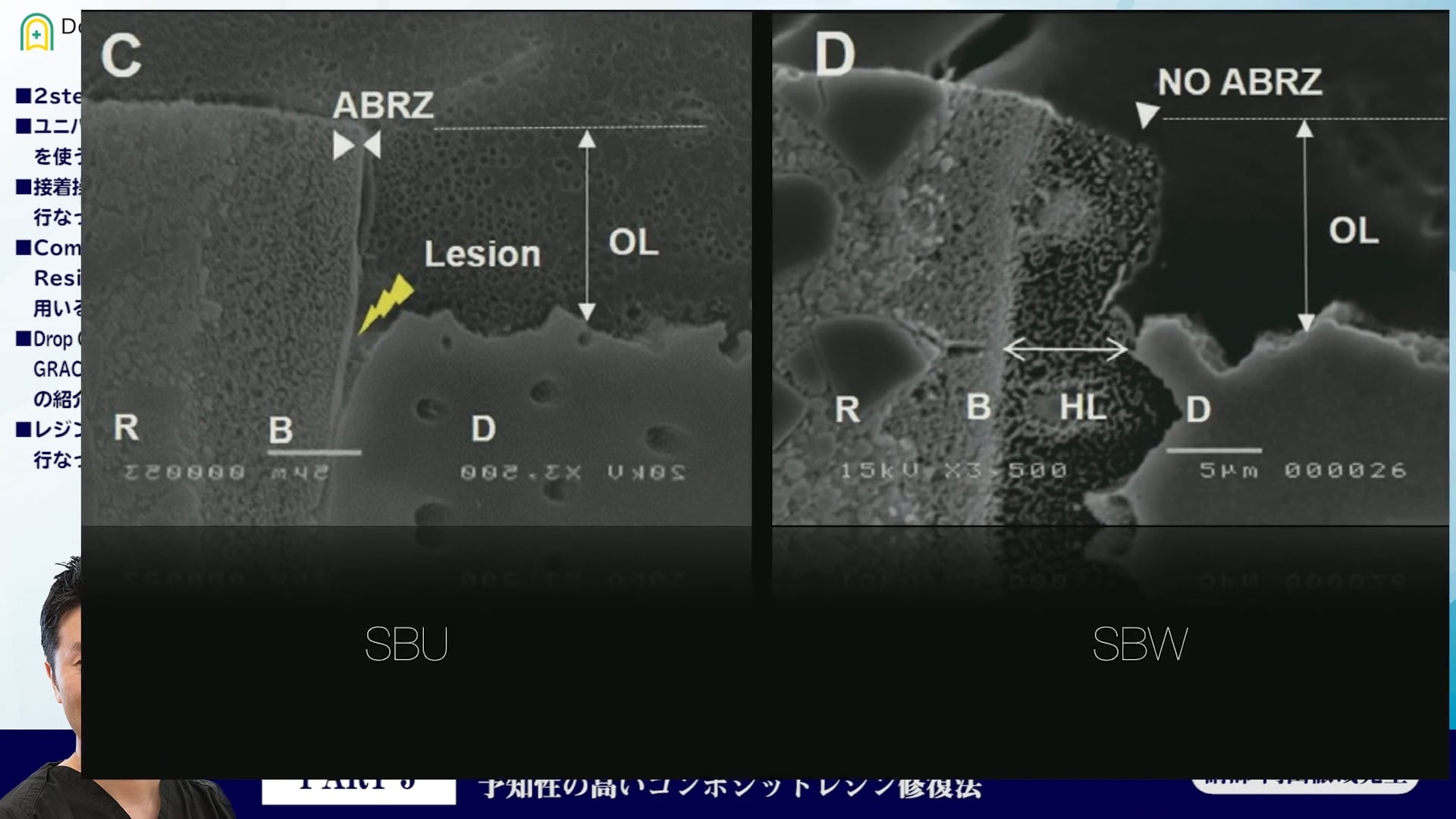 臨床知見録_4級窩洞CR修復_ユニバーサルシステムを使うべき症例