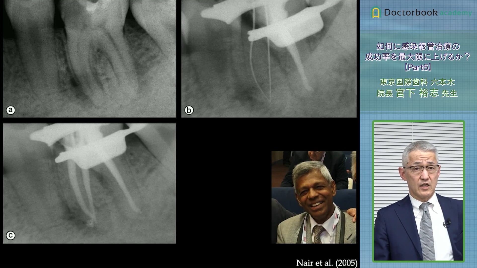 感染根管治療の成功率を上げる秘訣とは？宮下先生が手掛ける治療方法 #6