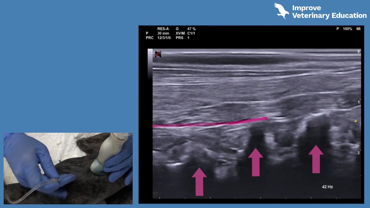 Ultrasound-guided erector spinae plane block