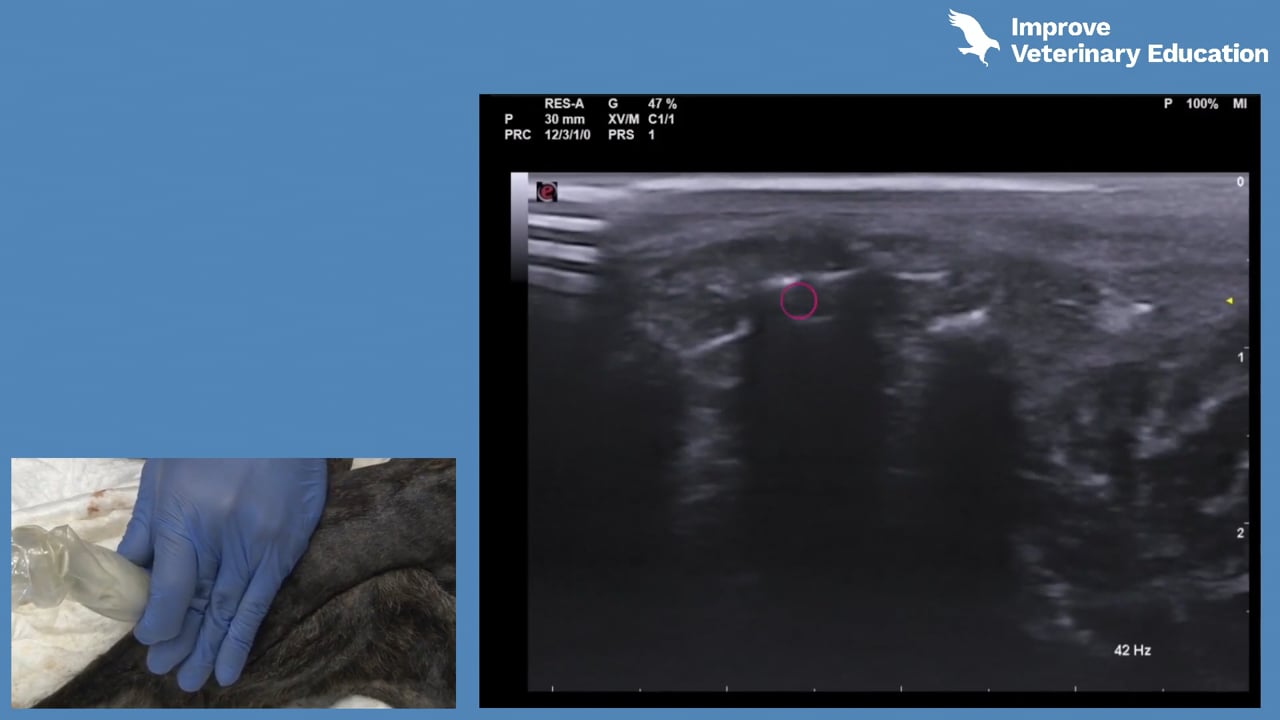 Ultrasound-guided sacro-coccygeal epidural