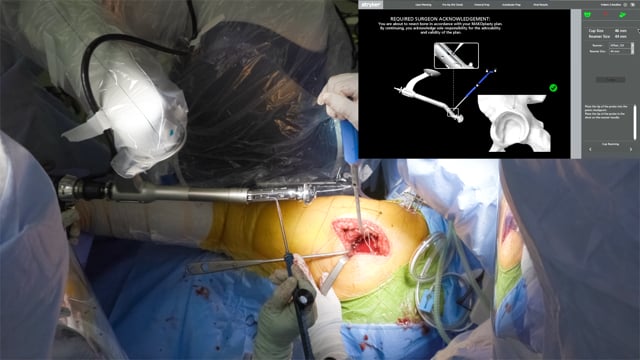 Robotic-Arm Assisted Total Hip Arthroplasty in Developmental Hip Dysplasia