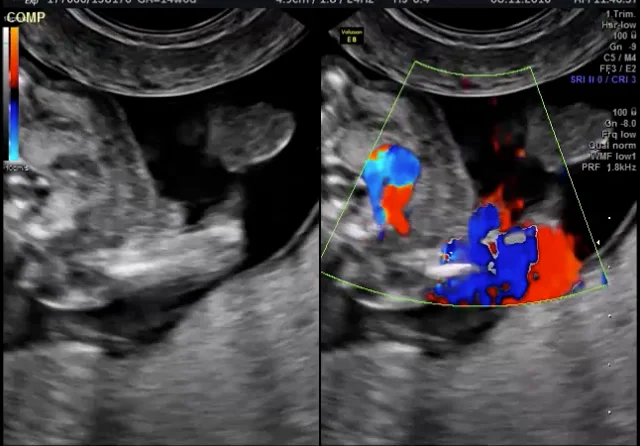 Umbilical cord entanglement, Radiology Case