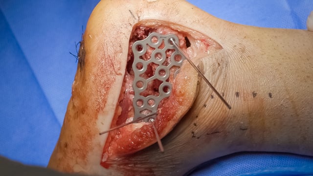 Acute Subtalar Arthrodesis for Sanders IV Calcaneus Fracture