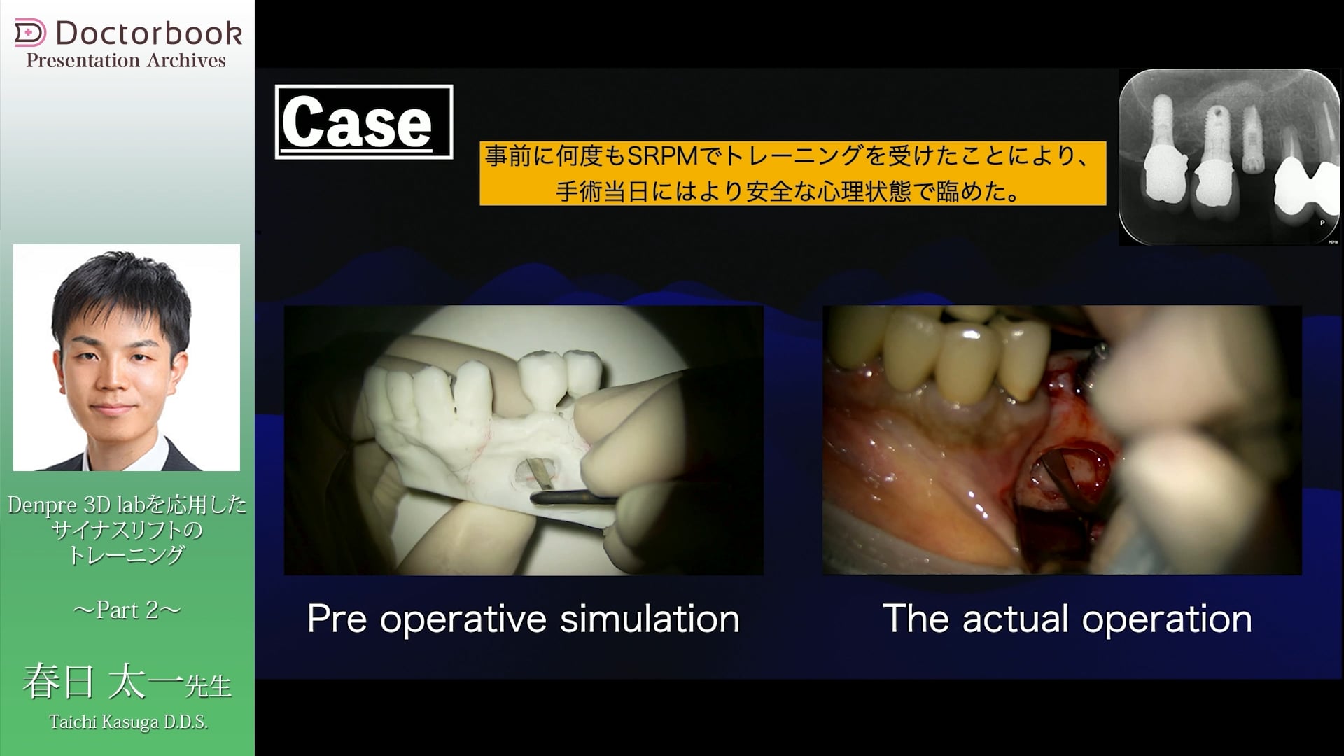  臨床知見録_サイナスリフト_症例から振り返る練習