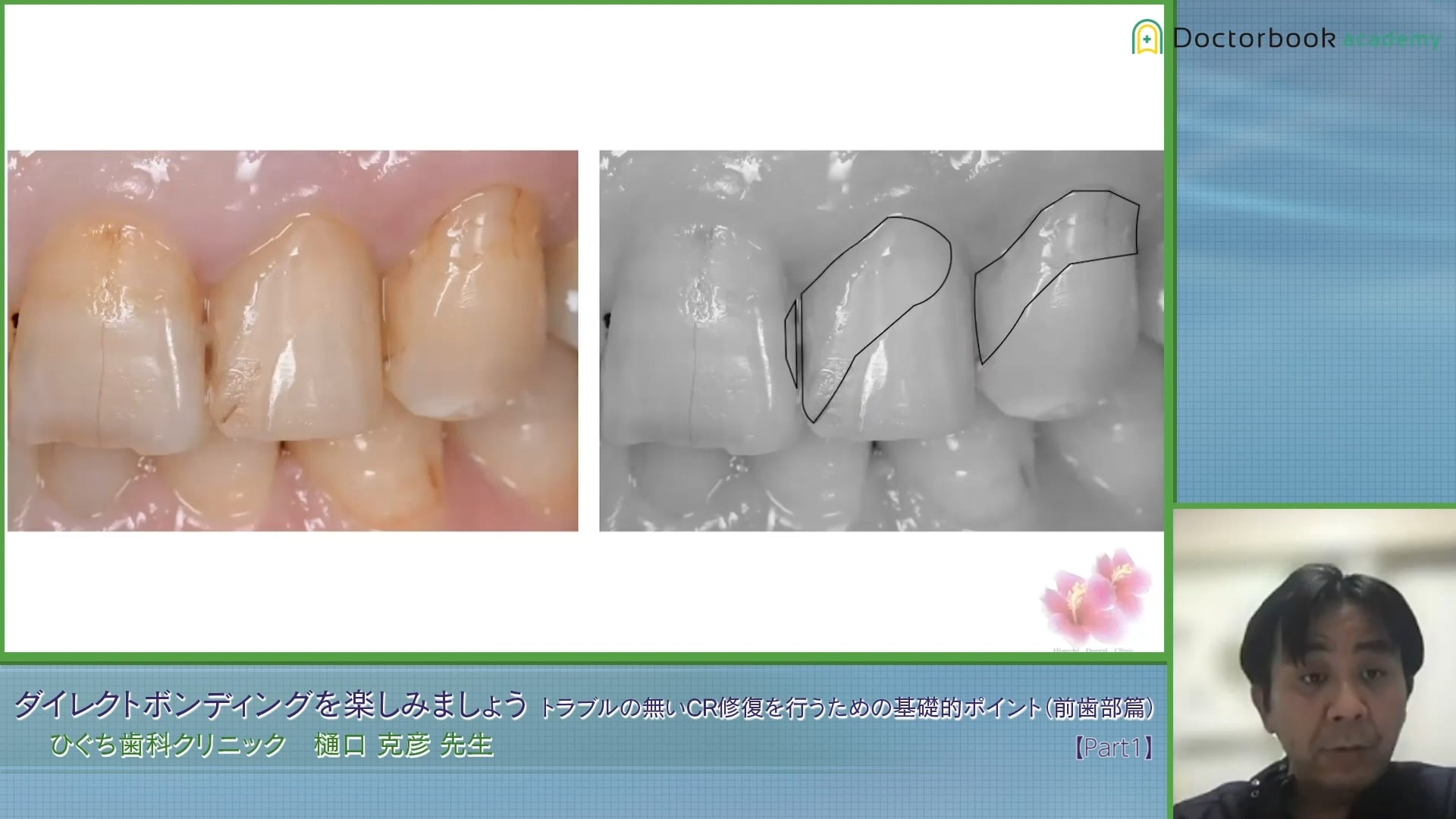 臨床知見録_4級窩洞CR修復_中切歯の形態の考え方・見方