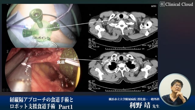 経縦隔アプローチの食道手術とロボット支援食道手術 Part2 | Clinical