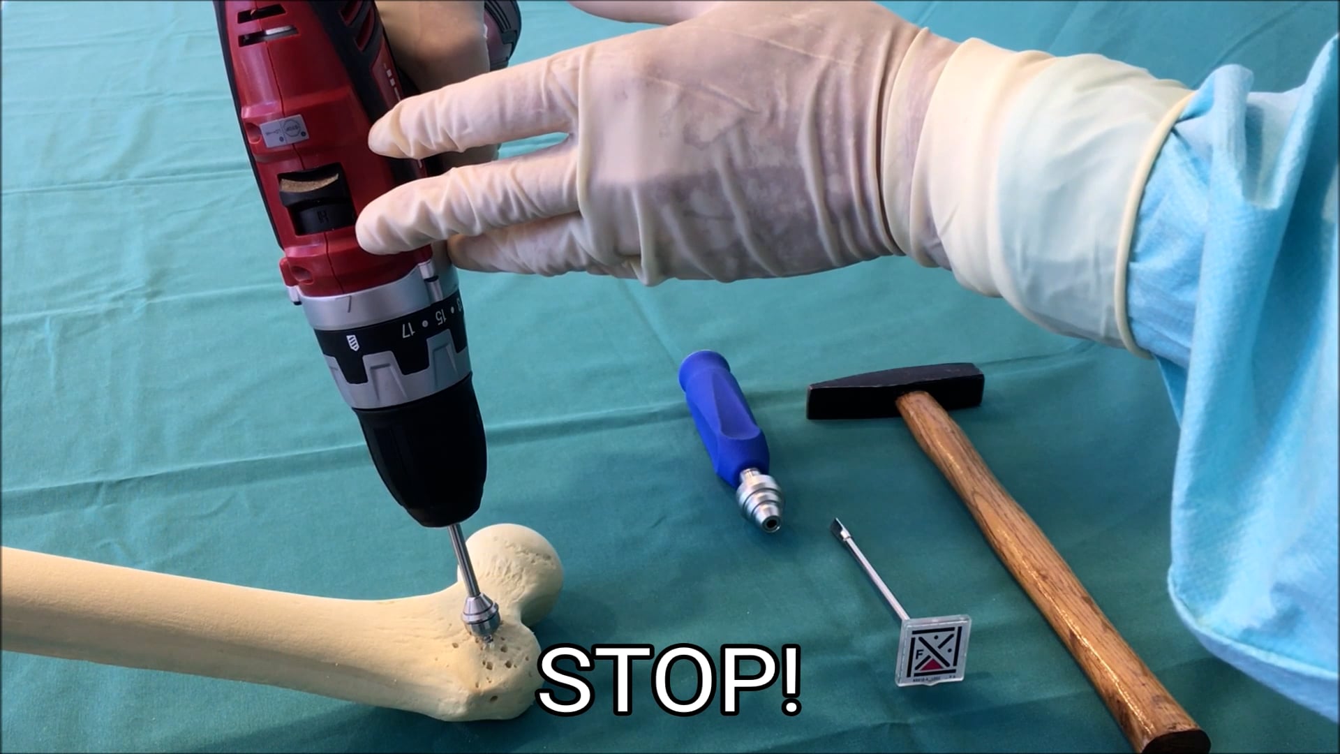 Femur screw position_insert technique.mp4 | Videos & Movies on Vimeo