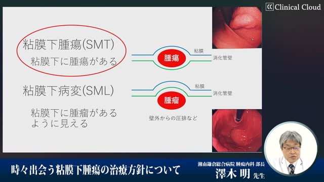 時々出会う粘膜下腫瘍の治療方針について