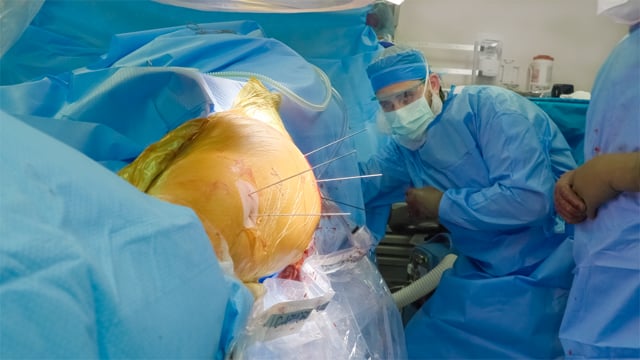 Staged Hip Arthroscopy with Labral Reconstruction Followed by Femoral Derotation Osteotomy
