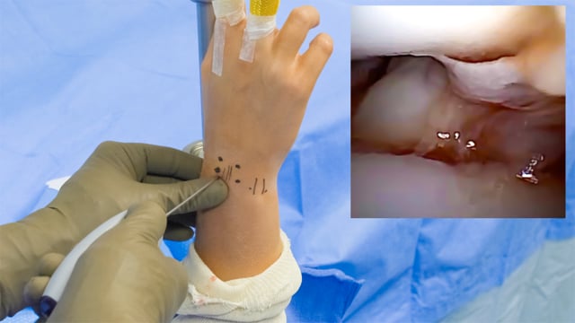 Nanoscope Wrist Arthroscopy with Open Scaphoid Nonunion Resection