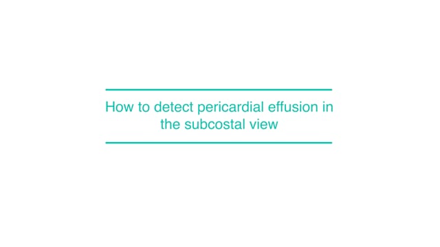 How to detect pericardial effusion in the subcostal view