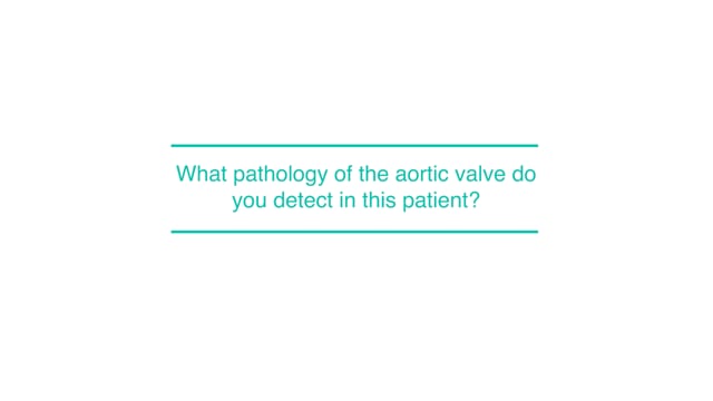 What pathology of the aortic valve do you detect in this patient?