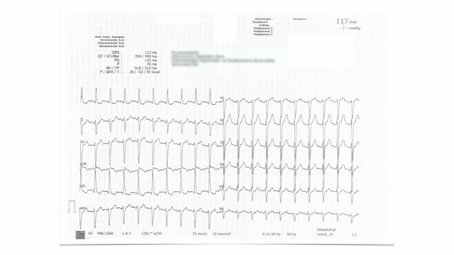 What can you find in patients with pulmonary embolism?