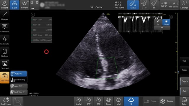 What causes of hypotension, and shock features can be detected in the apical echo views?