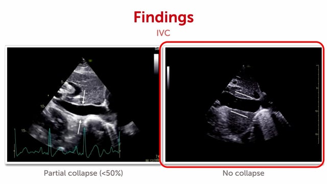 What does an abnormal collapsibility of the IVC look like?