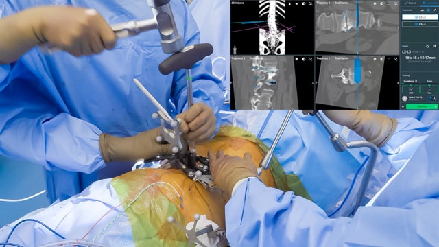 Single Position Spine Surgery: ALIF, LLIF, and Posterior Instrumentation and Fusion with Iliac Fixation