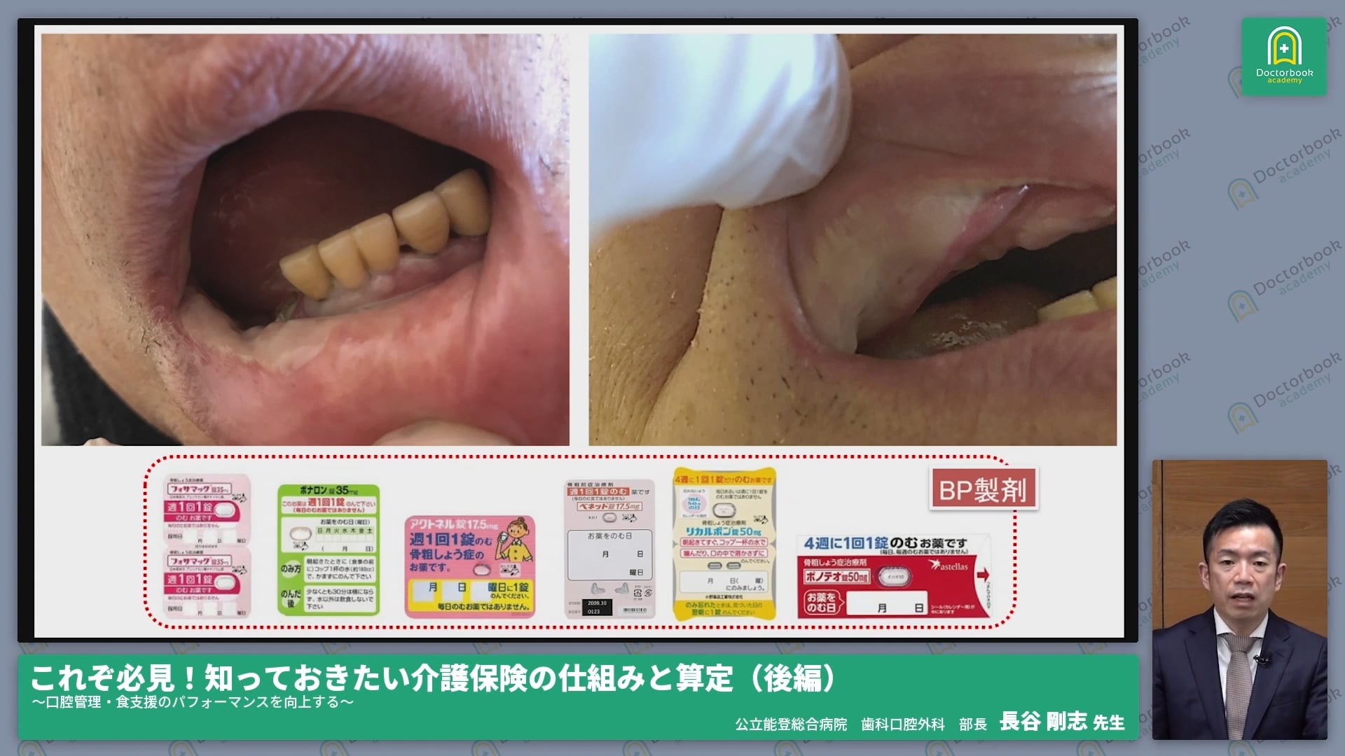 認知症患者の口腔粘膜の変化・咀嚼機能や食行動の特徴とは？