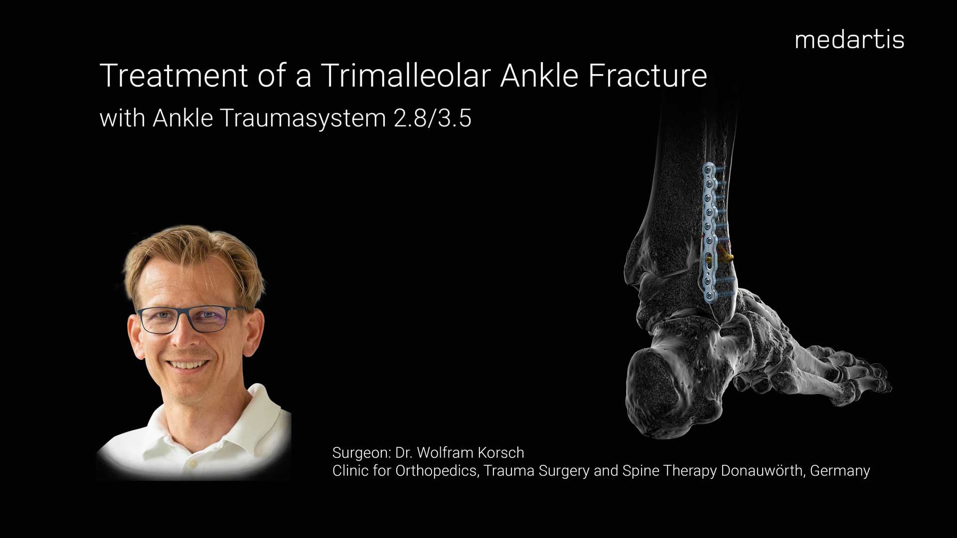 Trimalleolar Ankle Fracture