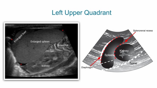 The left upper quadrant view in abdominal US of neonates and infants