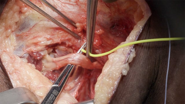 Aberrant Anatomy of the Lateral Knee in Posterolateral Corner Reconstruction