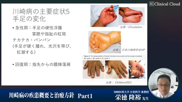 川崎病の疾患概要と治療方針　Part1