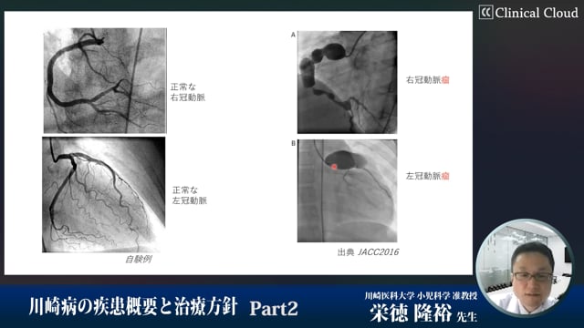 川崎病の疾患概要と治療方針　Part2