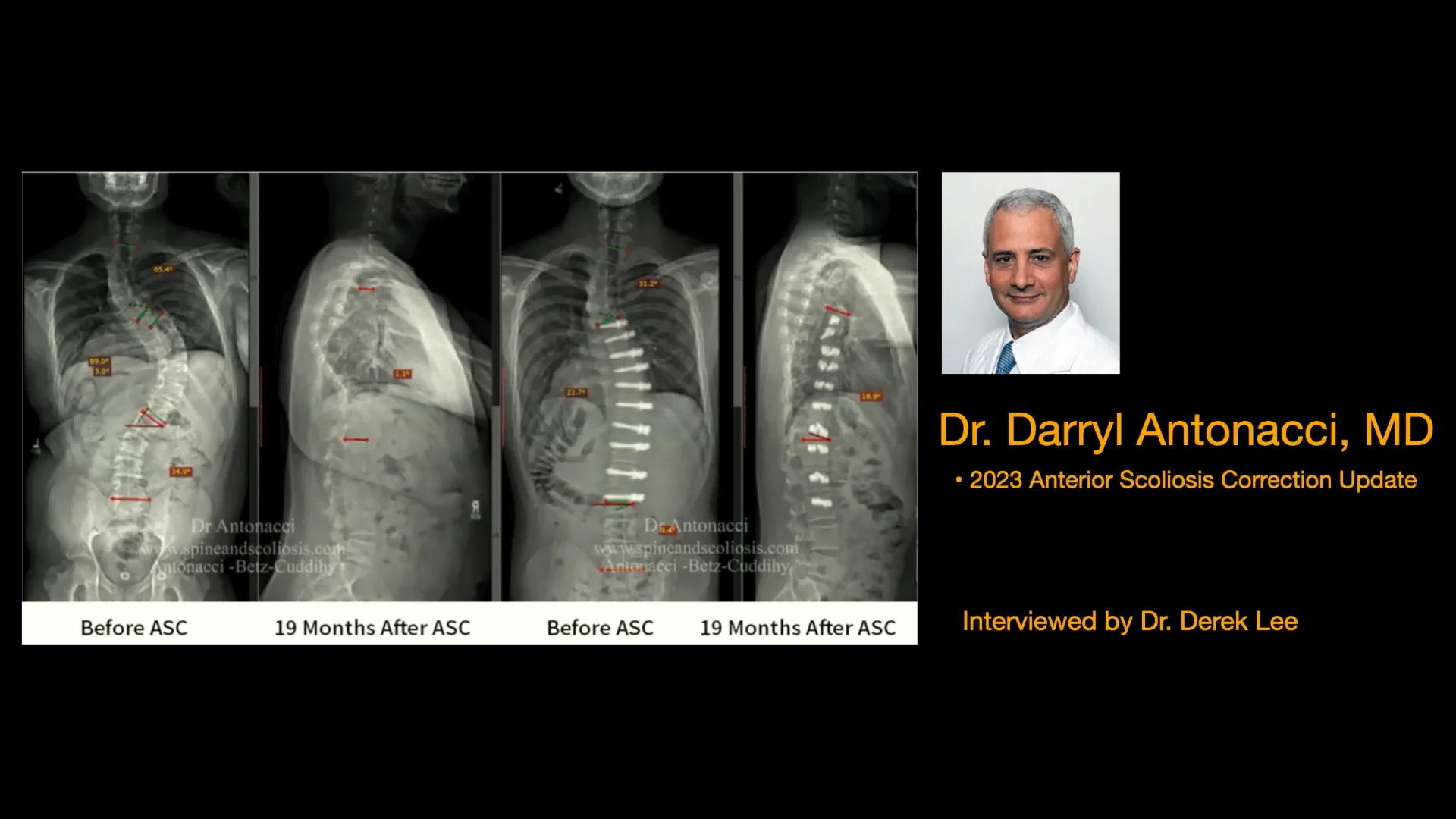 Scoliosis and Spine Surgeons | World Renowned Specialists Scoliosis and Spine Surgeons | World Renowned Specialists