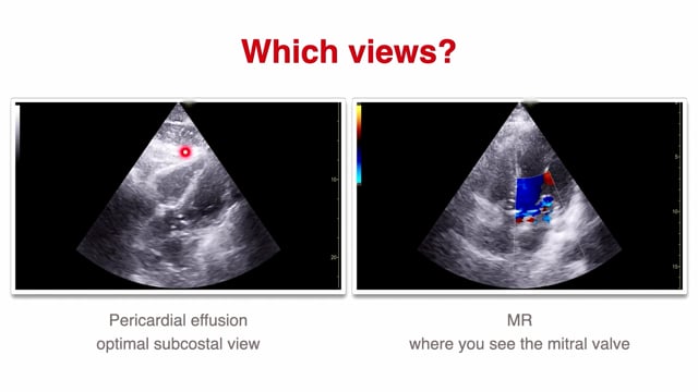 What complications in STEMI can be detected with POCUS?