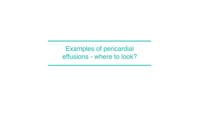 Examples of pericardial effusions - where to look?